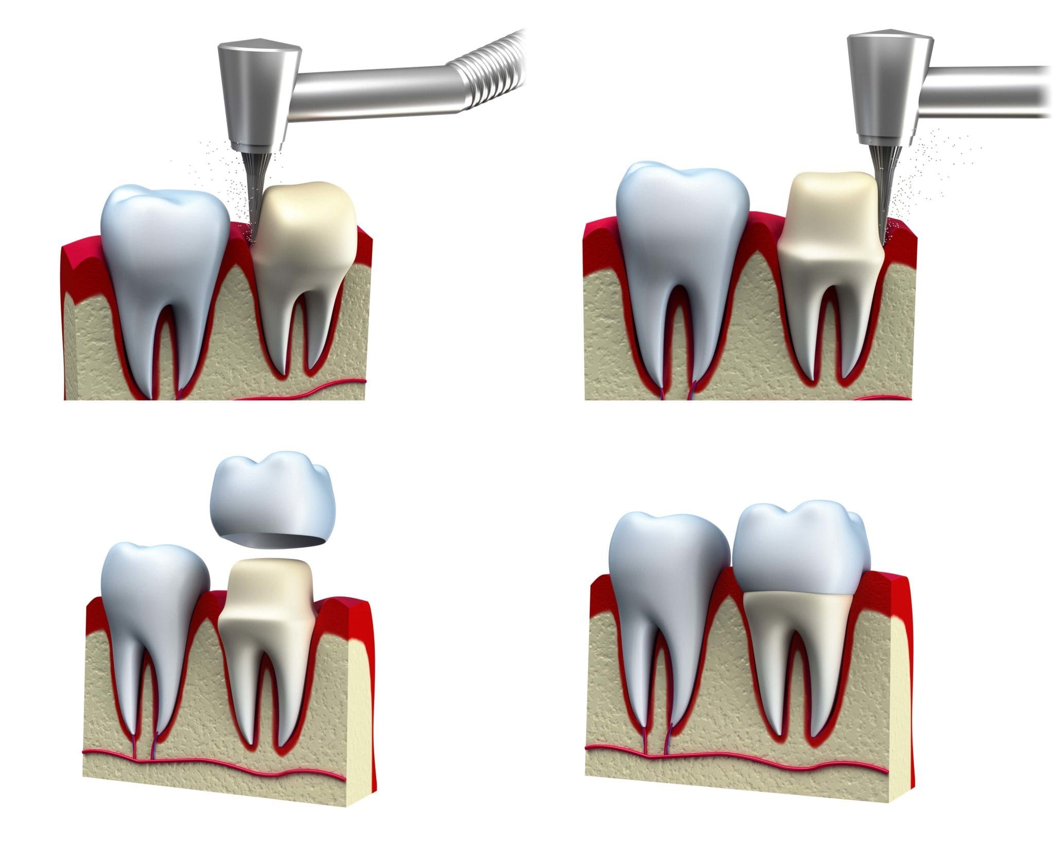 crowns-kids-world-pediatric-dentistry-san-antonio-tx