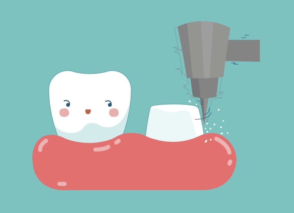 Cartoon of a tooth being prepared for a dental crown