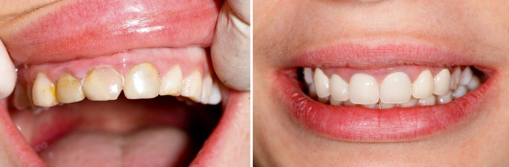 before and after dental crowns