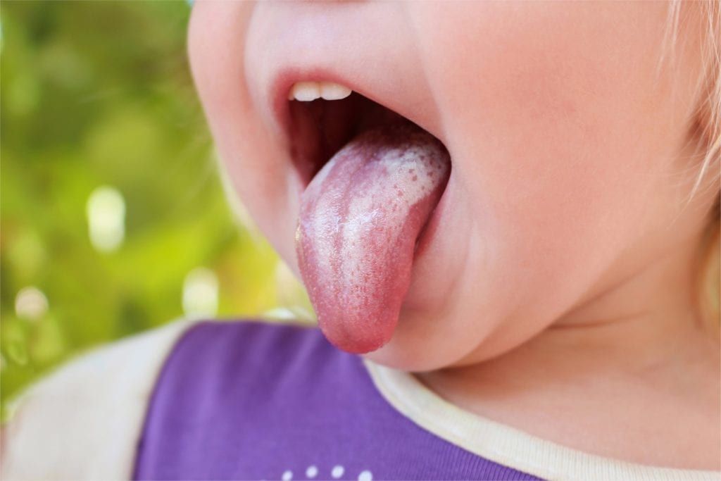 child with oral thrush on their tongue