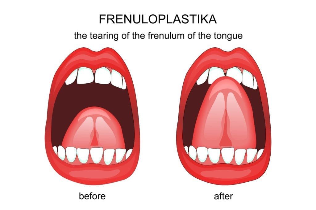 digital graphic of a frenectomy