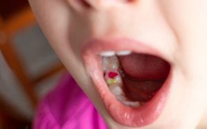 Child with colored dental fillings