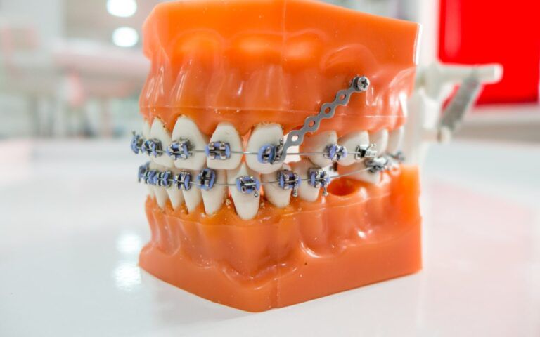 Orthodontic anchorage model