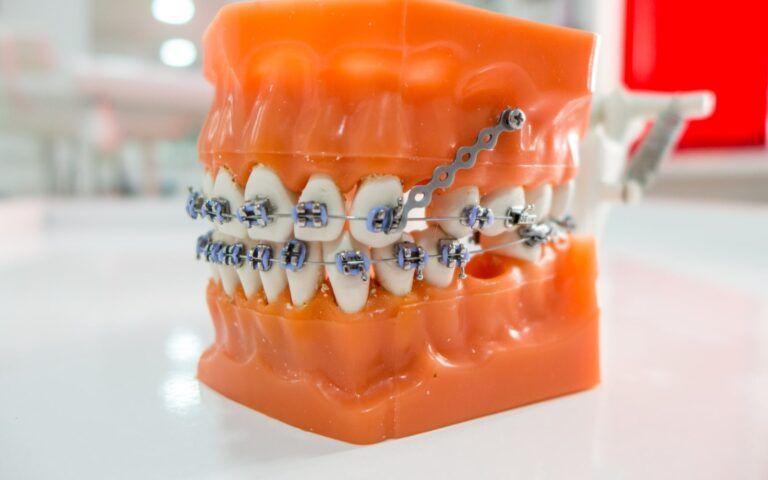 Orthodontic TADs
