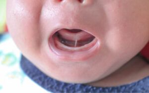 Newborn with Tongue Tie Condition