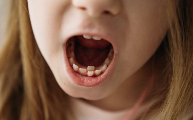 Child with Both Baby and Permanent Teeth