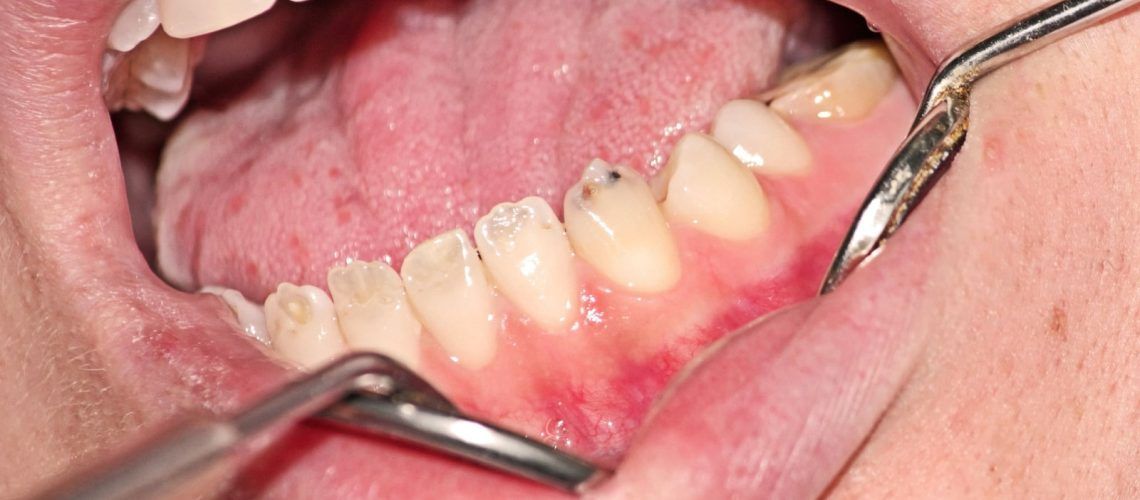 Patient with decayed teeth from denitinogenesis imperfecta