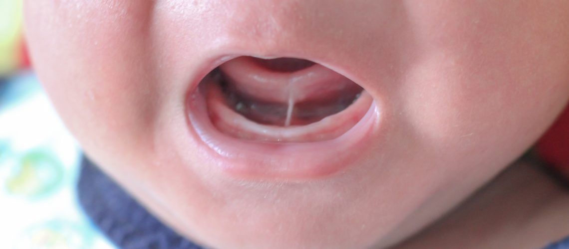 Newborn with Tongue Tie Condition