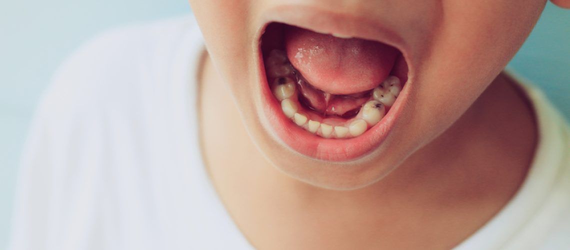 Close,Up,Child,Cavities